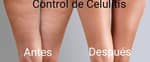 Control de Celulitis