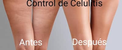 Control de Celulitis