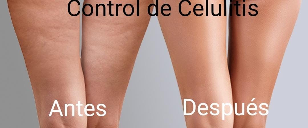 Control de Celulitis
