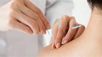 Servicio de acupuntura 