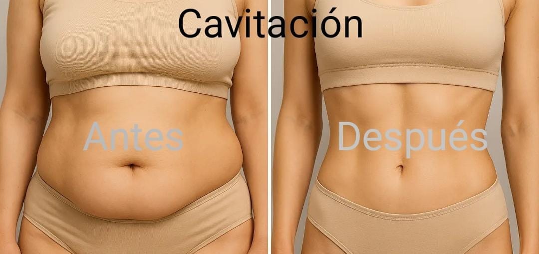 Cavitacion
