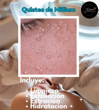 Eliminacion de milluns