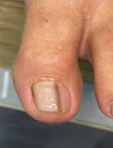 Reconstruccion ungueal medicada