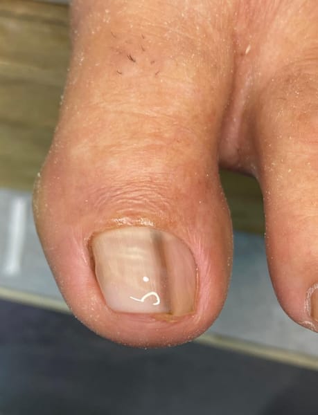 Reconstruccion ungueal medicada